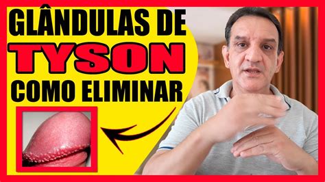 que son las glandulas de tyson|Pápulas perladas (glándulas de Tyson): qué son y。